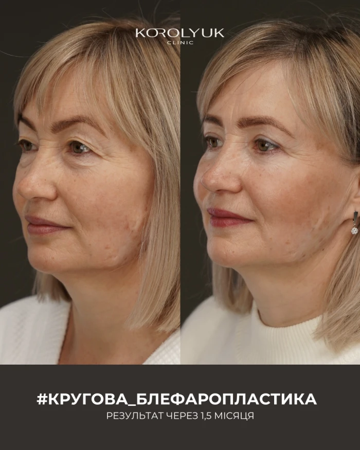 Блефаропластика