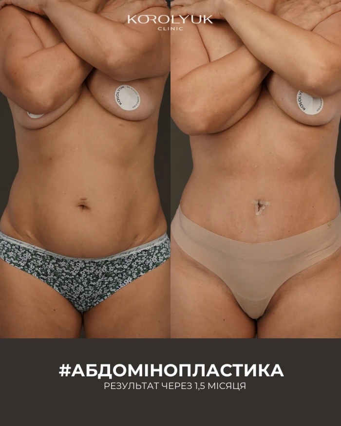Абдомінопластика