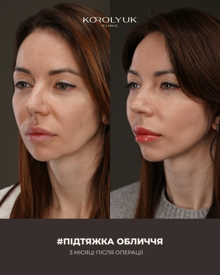 Підтяжка обличчя