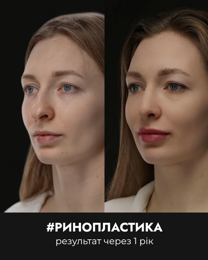Ринопластика