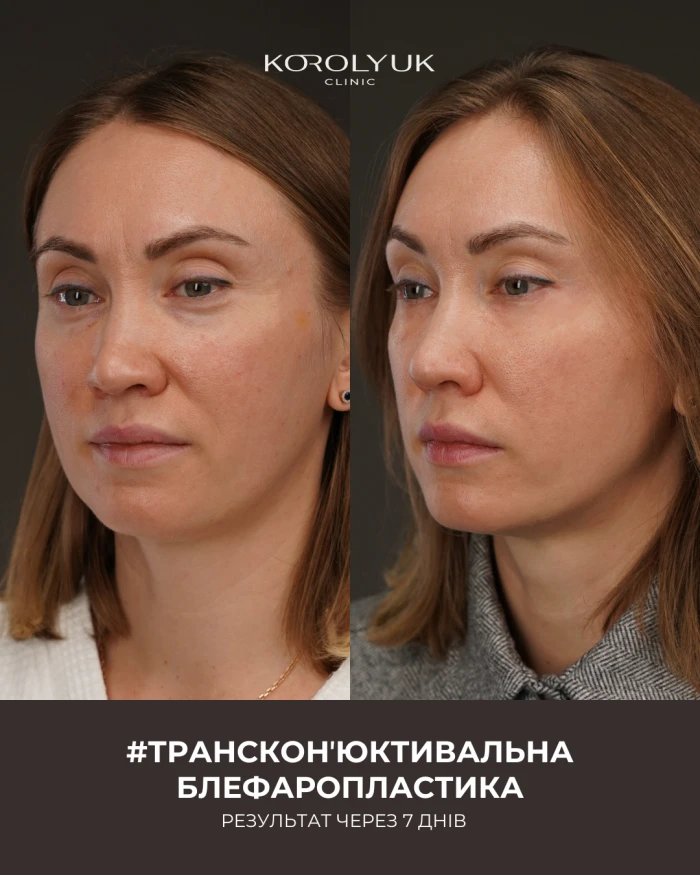 Блефаропластика