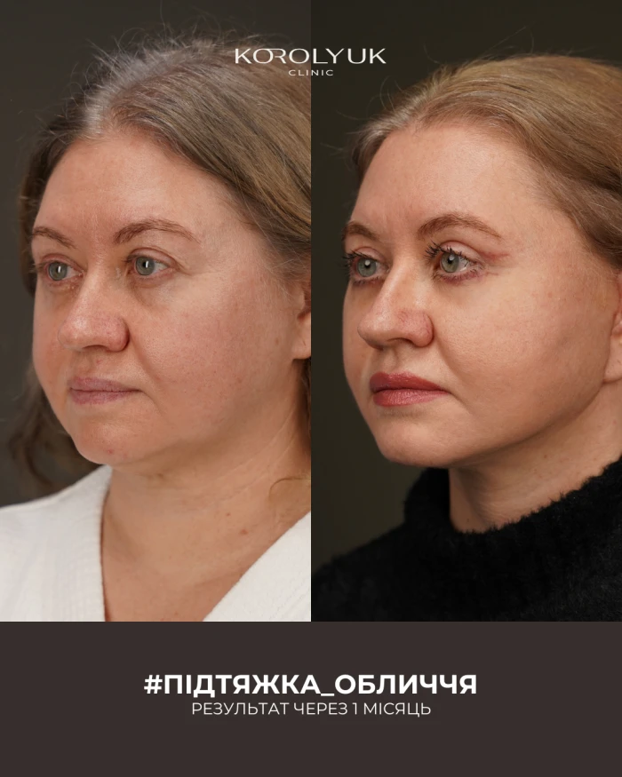 Підтяжка обличчя