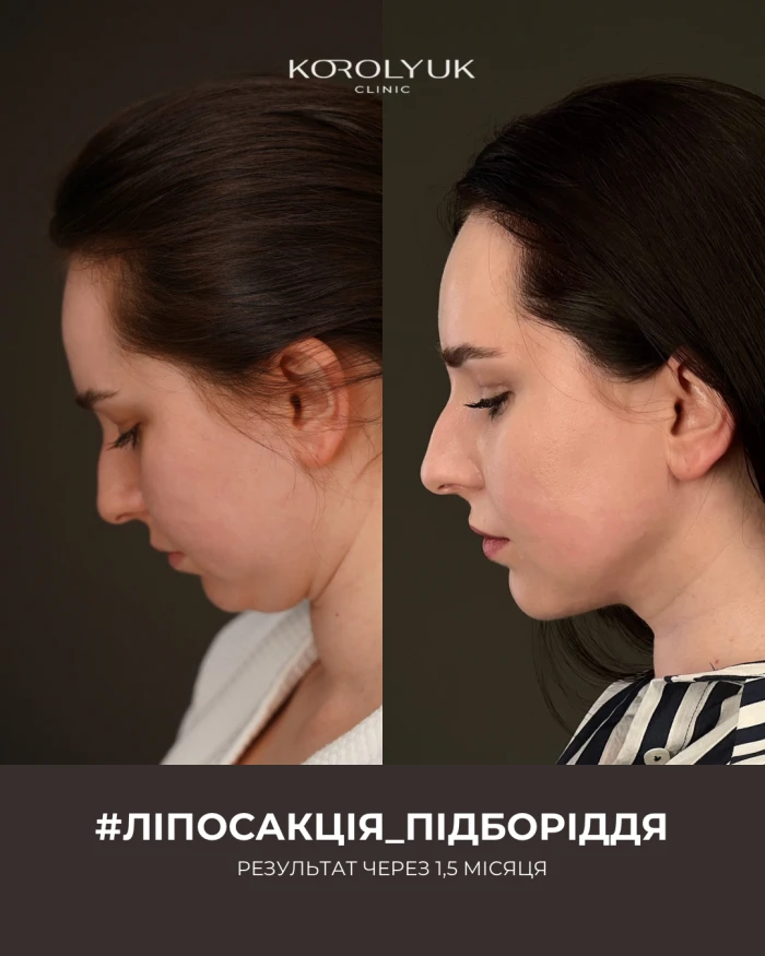 Ліпосакція обличчя