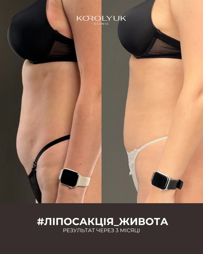 Ліпосакція тіла