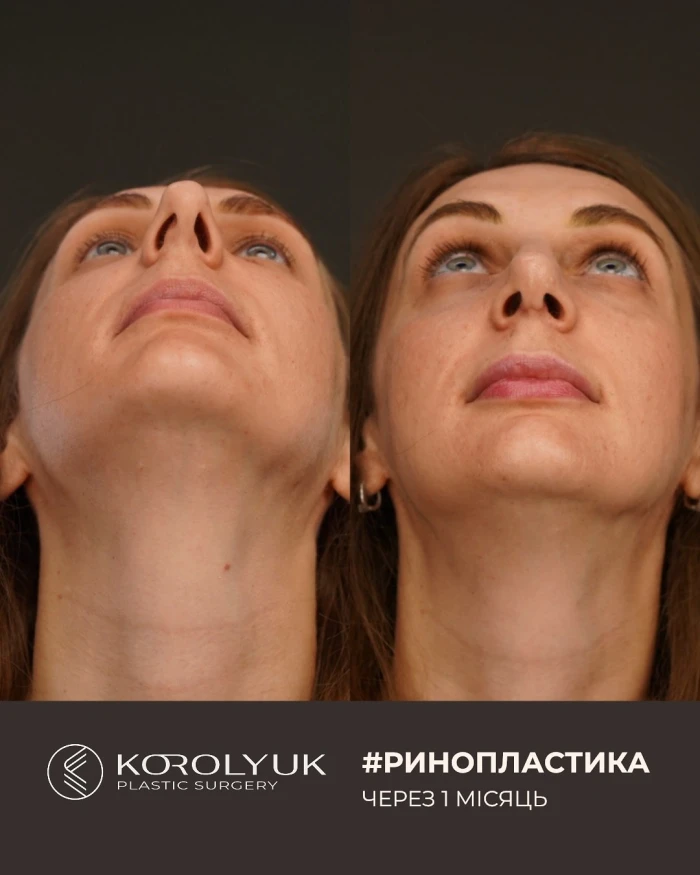 Пластика кінчика носа