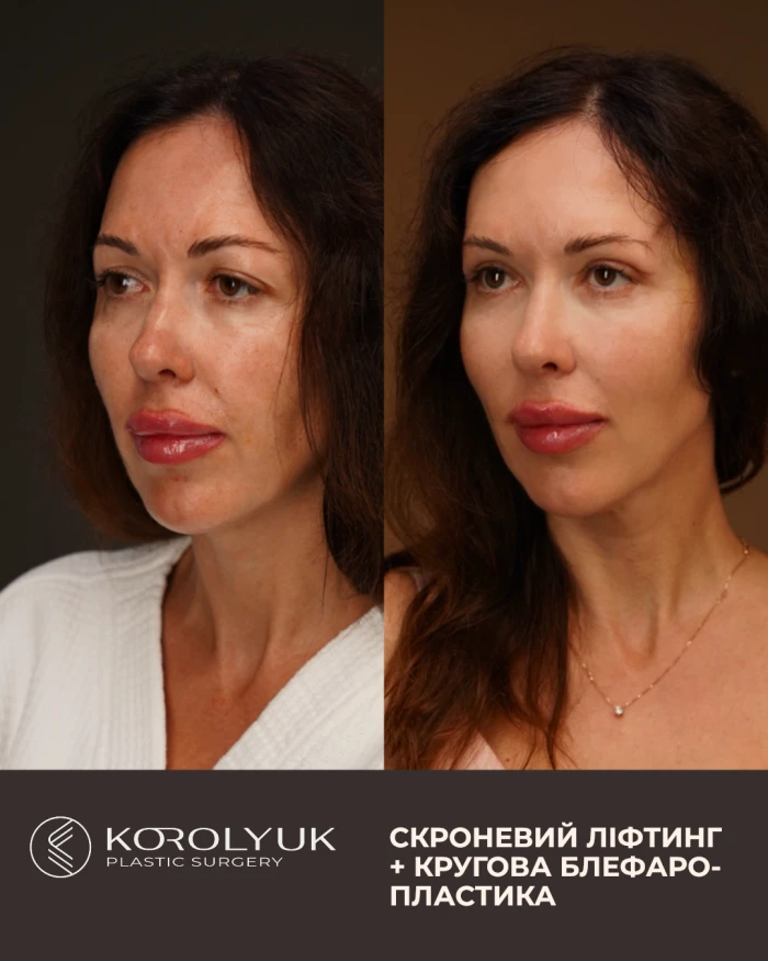 Блефаропластика