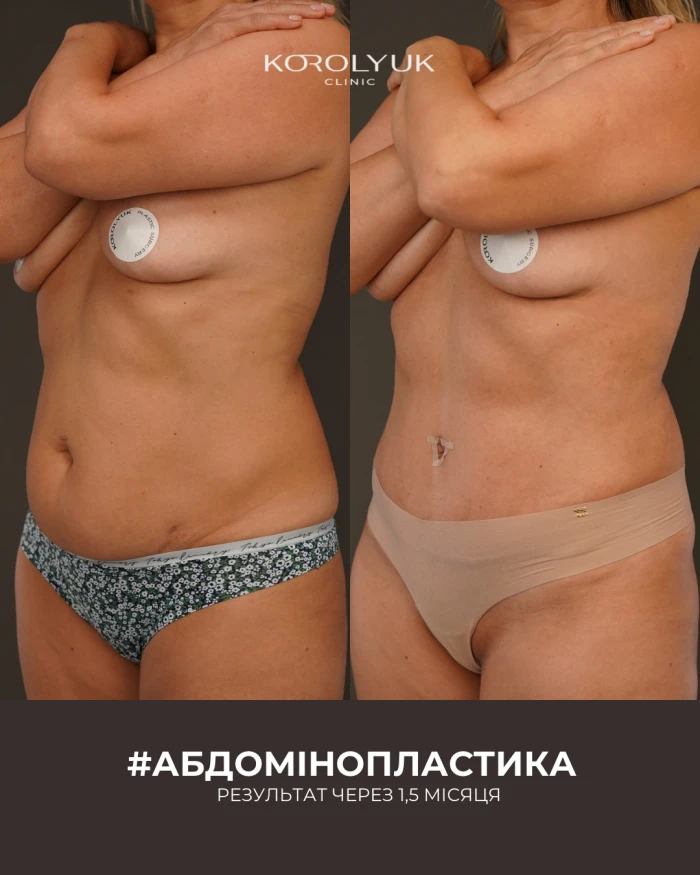 Абдомінопластика